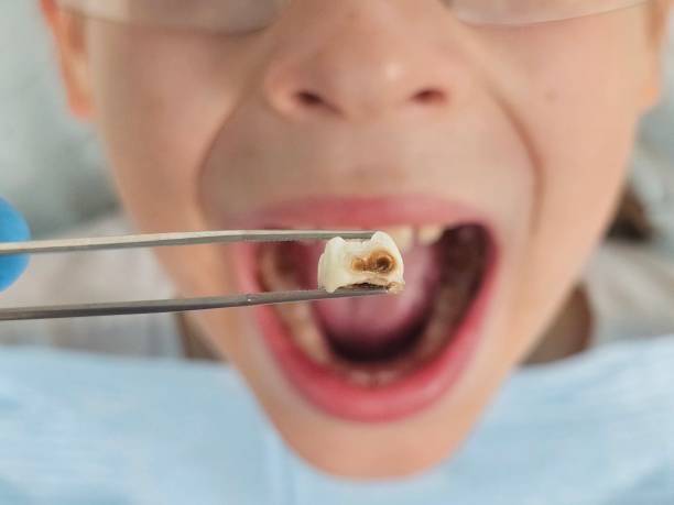 Best Emergency Dental Extractions in Johnson Creek, WI